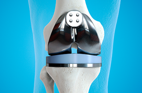 인공관절수술
