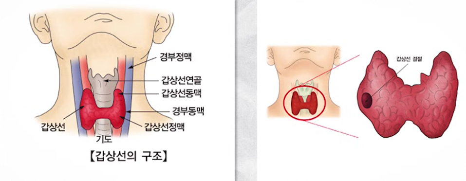 갑상선